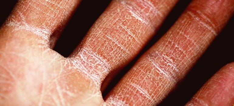 Suva koža sa unutrašnje strane dlana na prstima.