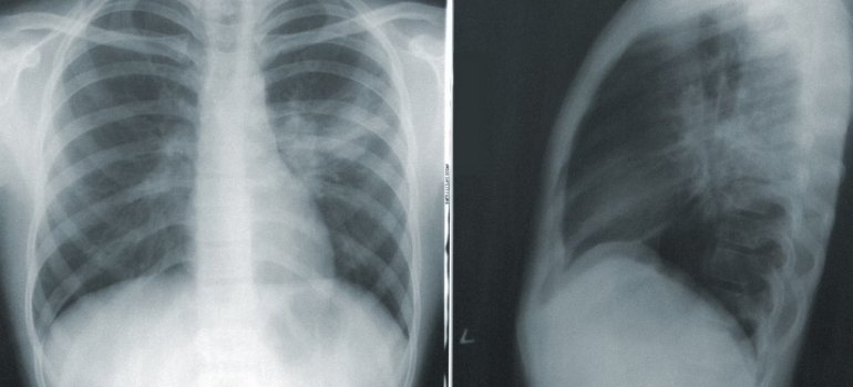 Рентген легких