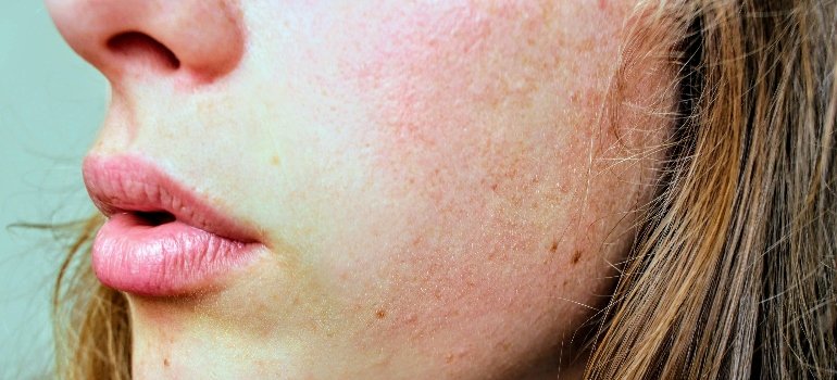 A person with redness on the cheeks is wondering how to recognize and treat lupus