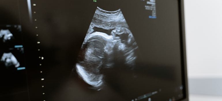 ultrazvuk bebe koja ima Patau sindrom